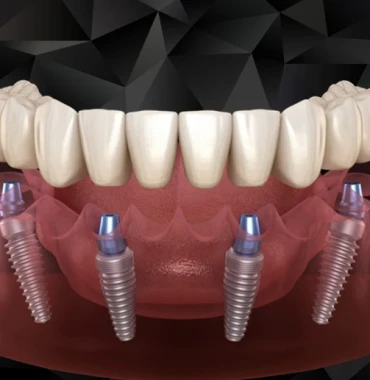 All on 4 Implantati