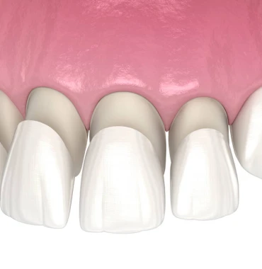 Laminate Veneers