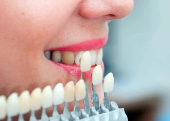 Veneerler İçin 4 8 10 Kuralı Nedir?