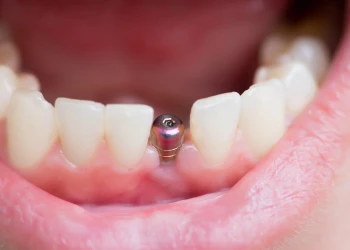 How Long Do Dental Implants Last?