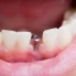 Ako dlho vydržia Zubné implantáty?