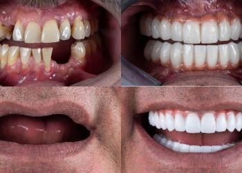 Türkiye'de Tam Diş İmplantı Ne Kadar?