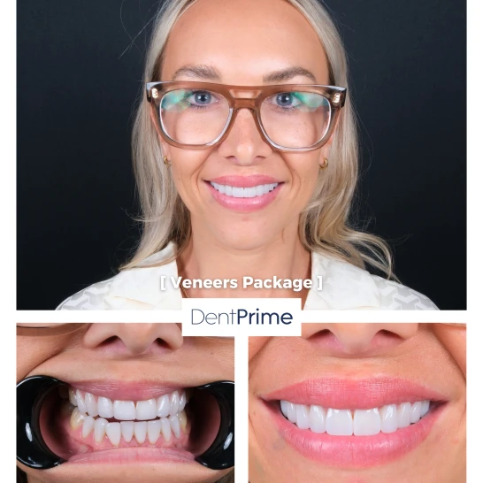 Smile Design Before After