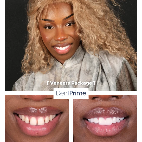 Smile Design Before After