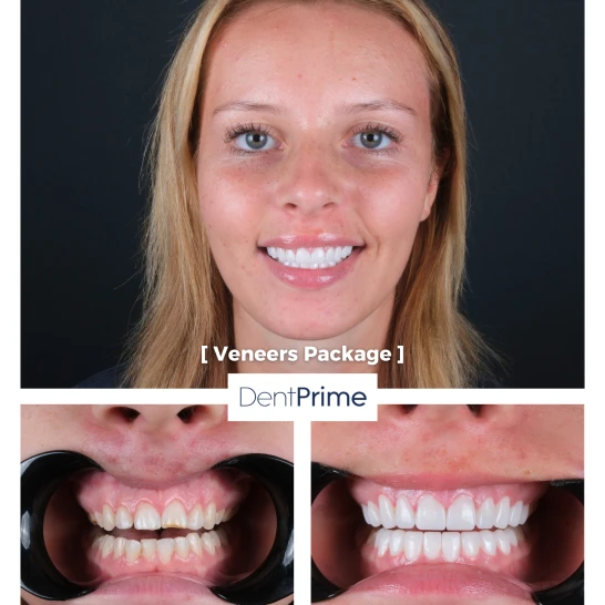 Smile Design Before After