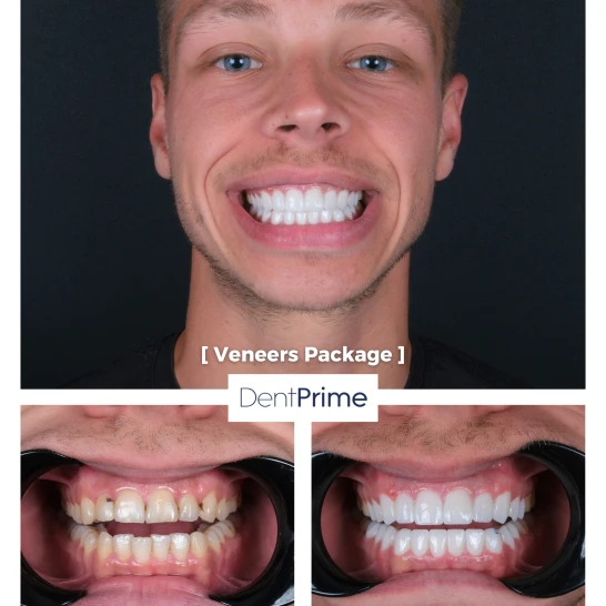 Smile Design Before After