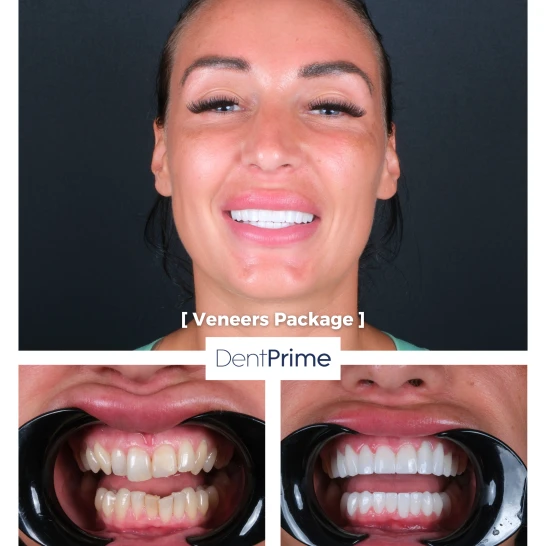 Smile Design Before After