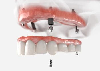 Tam Diş İmplantı Yaptırmanın En Ucuz Yolu Nedir?
