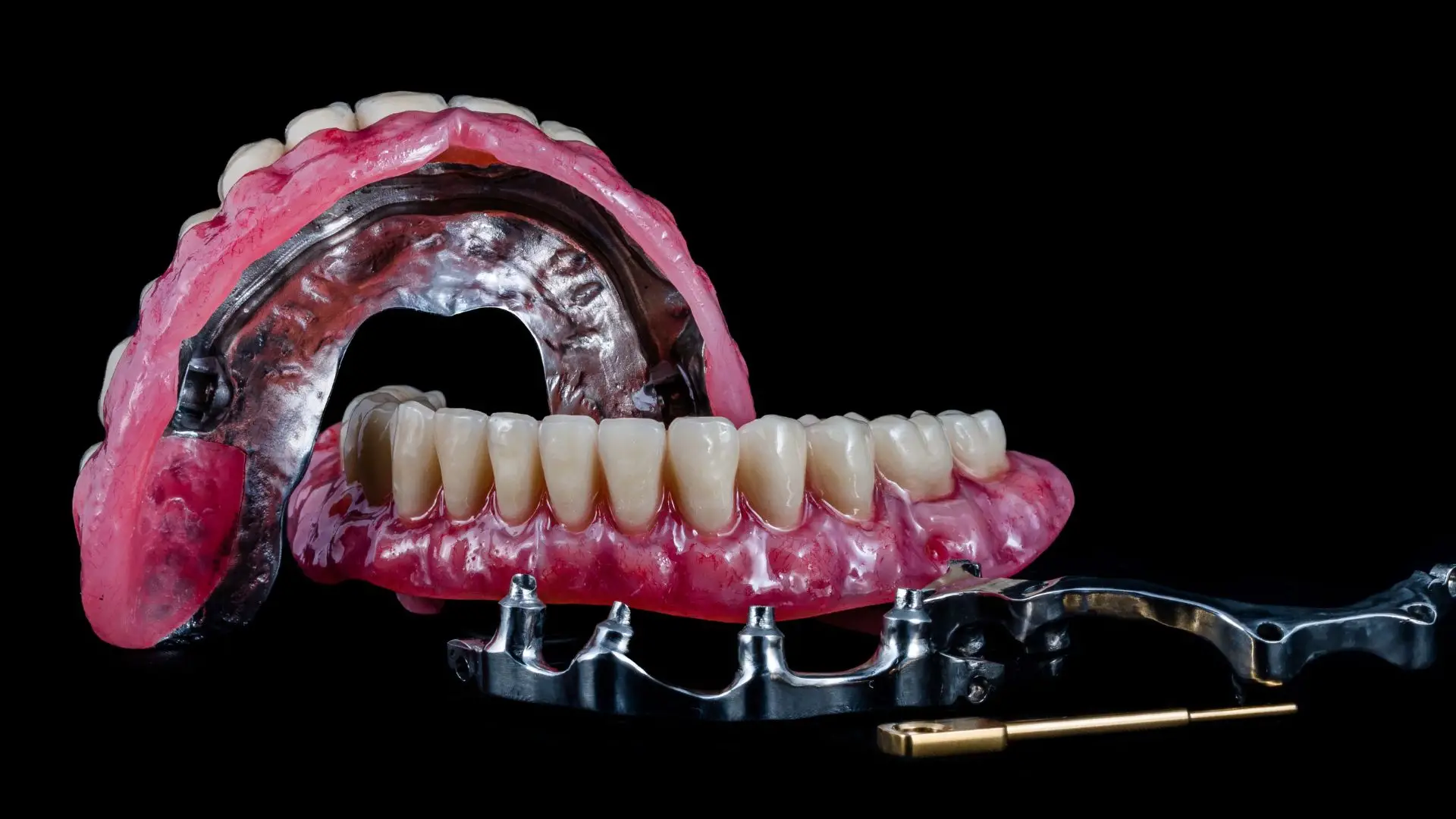 full mouth dental implant