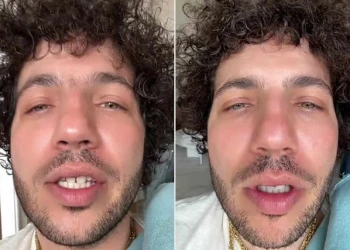 Benny Blanco Dişleri Öncesi ve Sonrası