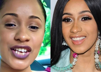 Cardi B Dişleri Öncesi ve Sonrası