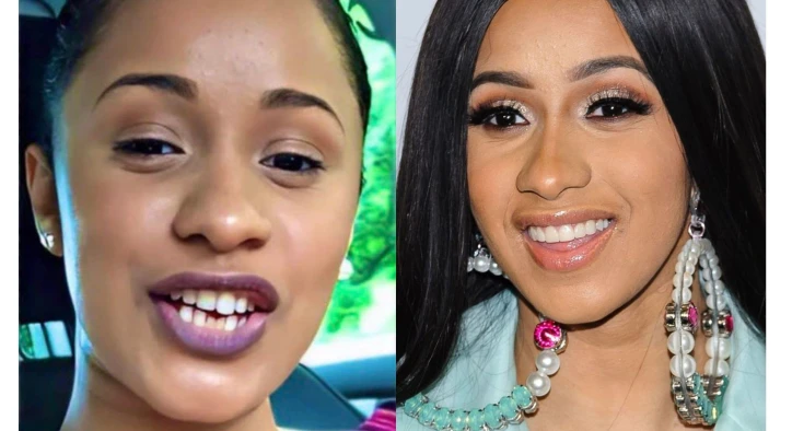Cardi B Teeth Before and After