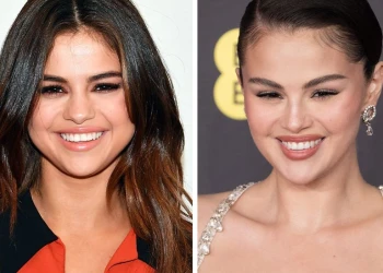 Selena Gomez Dişleri Öncesi ve Sonrası – Mükemmel Gülümsemesinin Arkasındaki Hikaye