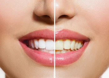 Sarı Diş Çözümleri: Evde ve Profesyonel