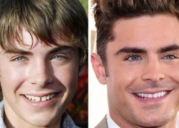 Zac Efron Dişleri Gülümseme Değişimi: İmplantlar ve Diş Aralığı Düzeltmesi