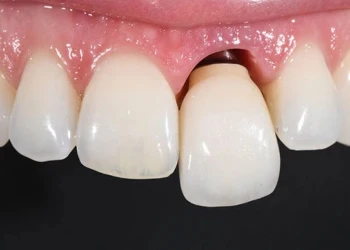 Sallanan Dişler İçin Ne Yapılmalı?