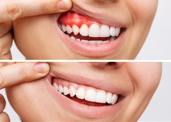 Diş Eti Çekilmesine Ne Yardımcı Olur?