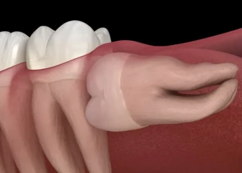Yirmi Yaş Dişleri Her Zaman Çekilmeli mi? Bilim ve Tartışmayı Keşfetmek