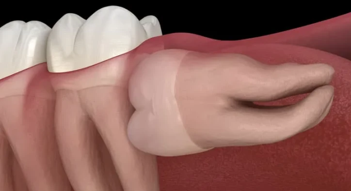 Do Wisdom Teeth Always Need to Be Removed? Exploring the Science and Controversy