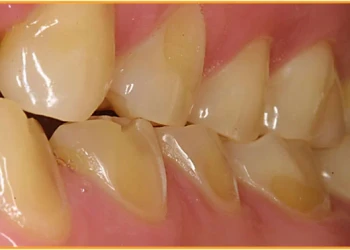 Diş Erozyonu Nedir?