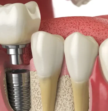 All on 6 Dental Implants
