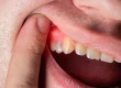 What You Need to Know About Antibiotic Use in Dental Infections?
