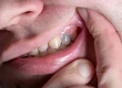 Blackened Teeth: What Are Causes and Treatments?