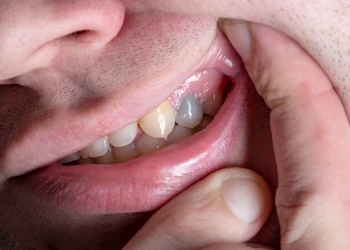 Blackened Teeth: What Are Causes and Treatments?