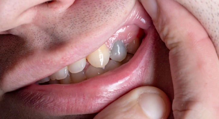 Blackened Teeth: What Are Causes and Treatments?
