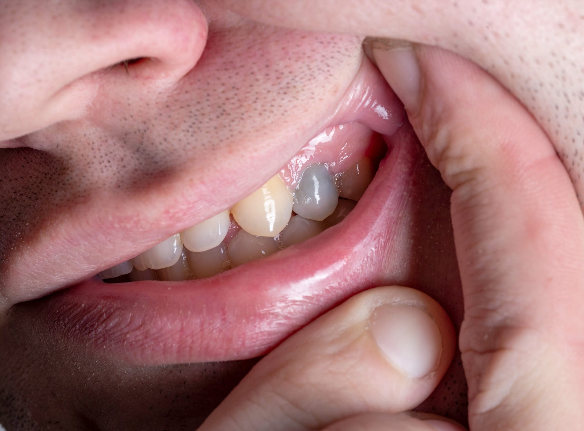 Blackened Teeth: Causes, Color Changes, and Scientific Perspectives