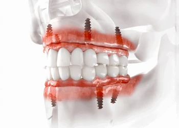 2026'da Diş İmplantları Neden Patlama Yapıyor