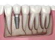 Can You Get Dental Implants If You Have Full Dentures?