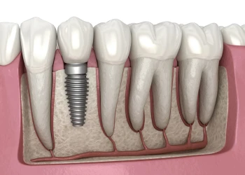 Can You Get Dental Implants If You Have Full Dentures?
