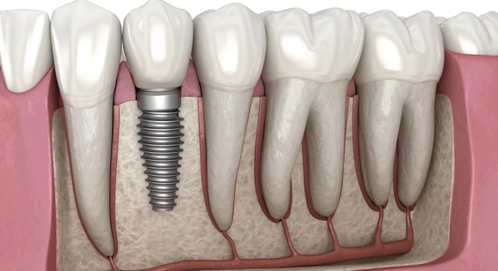 Can You Get Dental Implants If You Have Full Dentures?