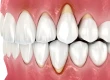 Why Do Gums Appear When Smiling?