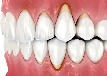 Why Do Gums Appear When Smiling?