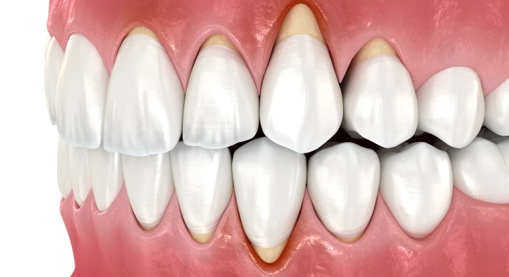 Why Do Gums Appear When Smiling?