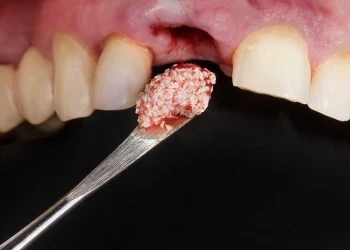 Can Dental Bone Grafts Lead to Cancer? What You Need to Know