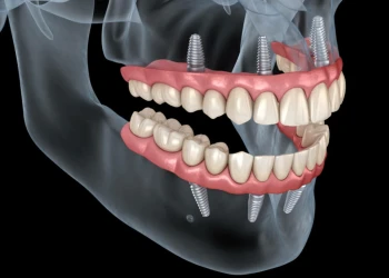 Can I Eat a Banana After Dental Implant Surgery?