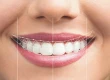 Is a Hollywood Smile Permanent? How to Make It Last