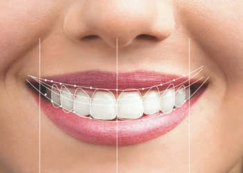 Is Hollywood Smile the Same as Veneers? Key Differences