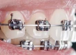 How Long Do Braces Take to Straighten Teeth?