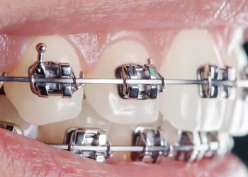 How Long Do Braces Take to Straighten Teeth?