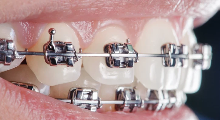 How Long Do Braces Take to Straighten Teeth?