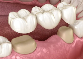 How Long Will a Maryland Dental Bridge Last? Benefits & Care