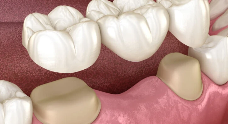 How Long Will a Maryland Dental Bridge Last? Benefits & Care