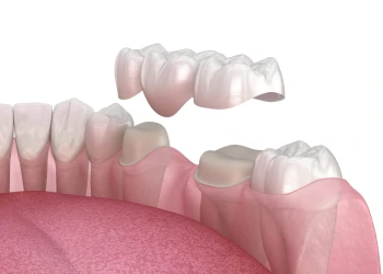 What is the CDT Code for a Dental Bridge?