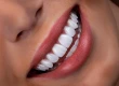 Is Hollywood Smile the Same as Veneers? Key Differences