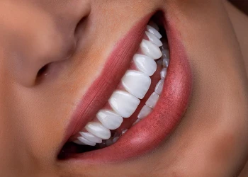 Is Hollywood Smile the Same as Veneers? Key Differences