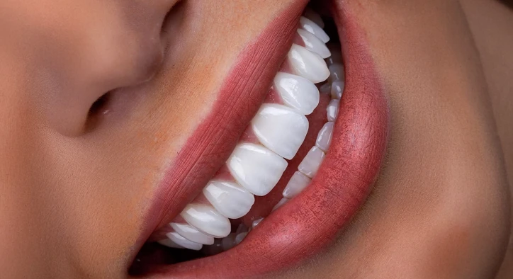 Is Hollywood Smile the Same as Veneers? Key Differences
